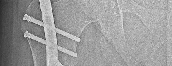 Zabieg wydłużania kości kończyny dolnej