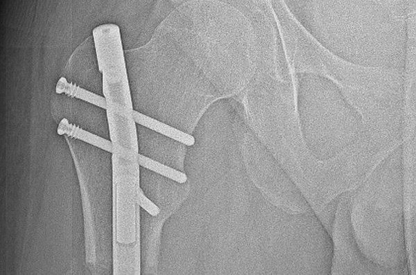 Lower limb lengthening procedure