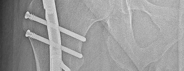 Lower limb lengthening