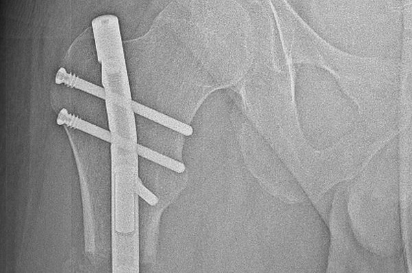 Zabieg wydłużania kości kończyny dolnej